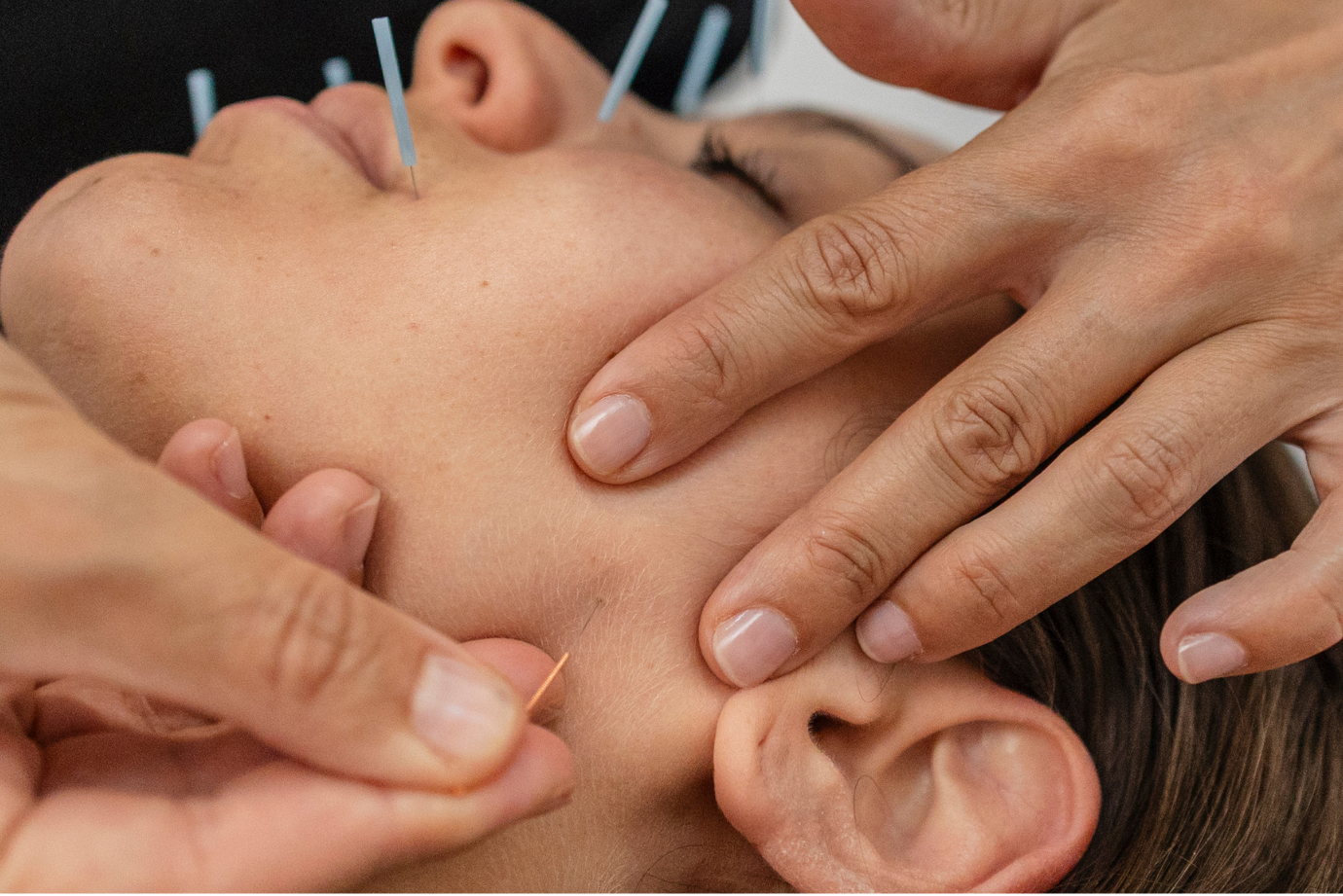 Acupuntura Estética Facial: O “Lifting Natural” que Rejuvenesce sem Cirurgia ou Produtos Químicos