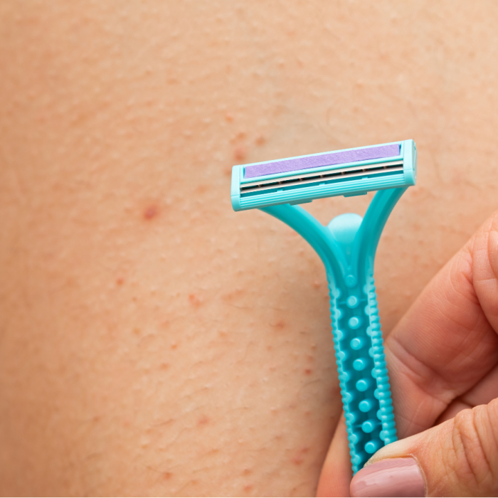 Tratamento para foliculite e pelos encravados com laser