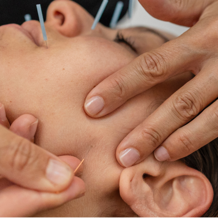 Aplicação de acupuntura estética facial para rejuvenescimento